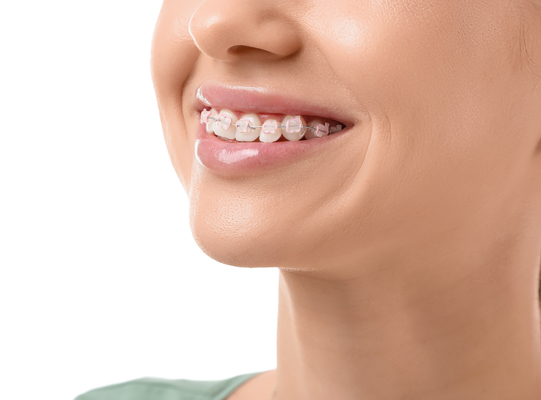 Traditional Braces: A Time Tested Method For Achieving A Perfect Smile