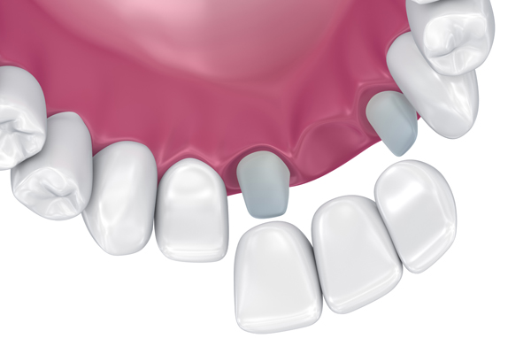 Why Dental Bridges Are An Effective Tooth Restoration