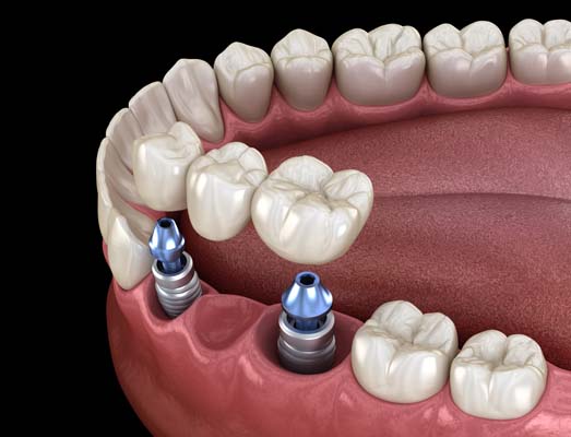 Tips For Dental Bridges Aftercare