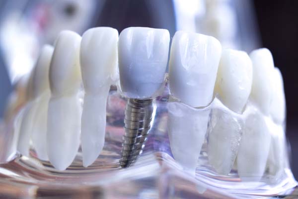 Benefits Of Dental Implants