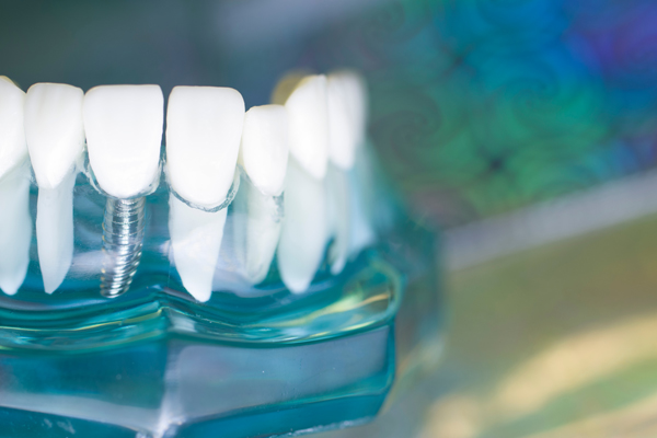 The Three Steps Of Getting Dental Implants