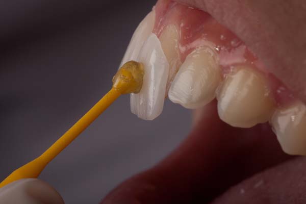 How Dental Veneers Can Strengthen Your Teeth