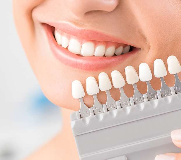 Chicago Dental Veneers and Dental Laminates